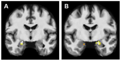 Emotional Recognition in Patients With Mesial Temporal Epilepsy Associated With Enlarged Amygdala